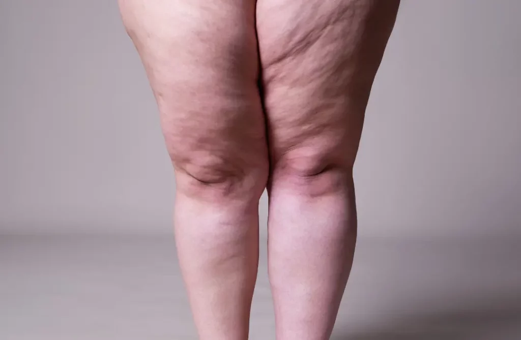 lipedema o linfedema