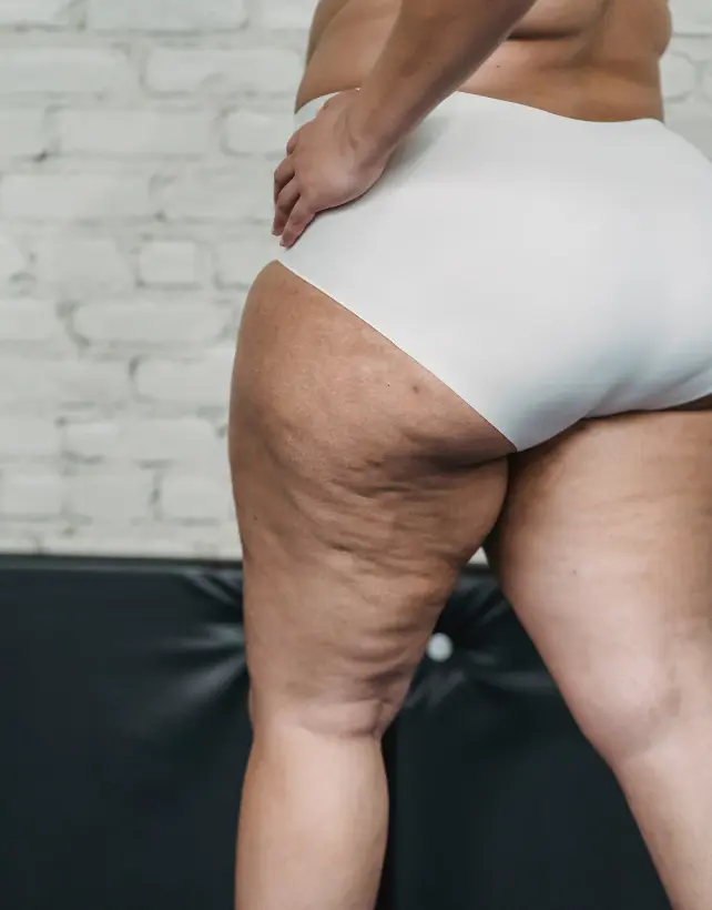 sintomas lipedema